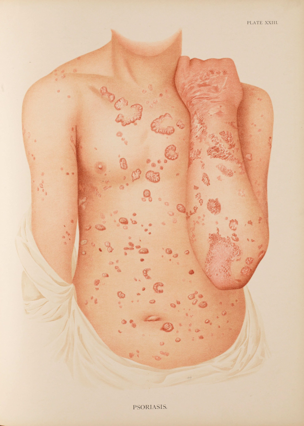 Buchumschlag mit einer Illustration eines Mannes mit einem roten Fleck auf der Brust, der wahrscheinlich Psoriasis darstellt, und Text, der Informationen über die Erkrankung bereitstellt.